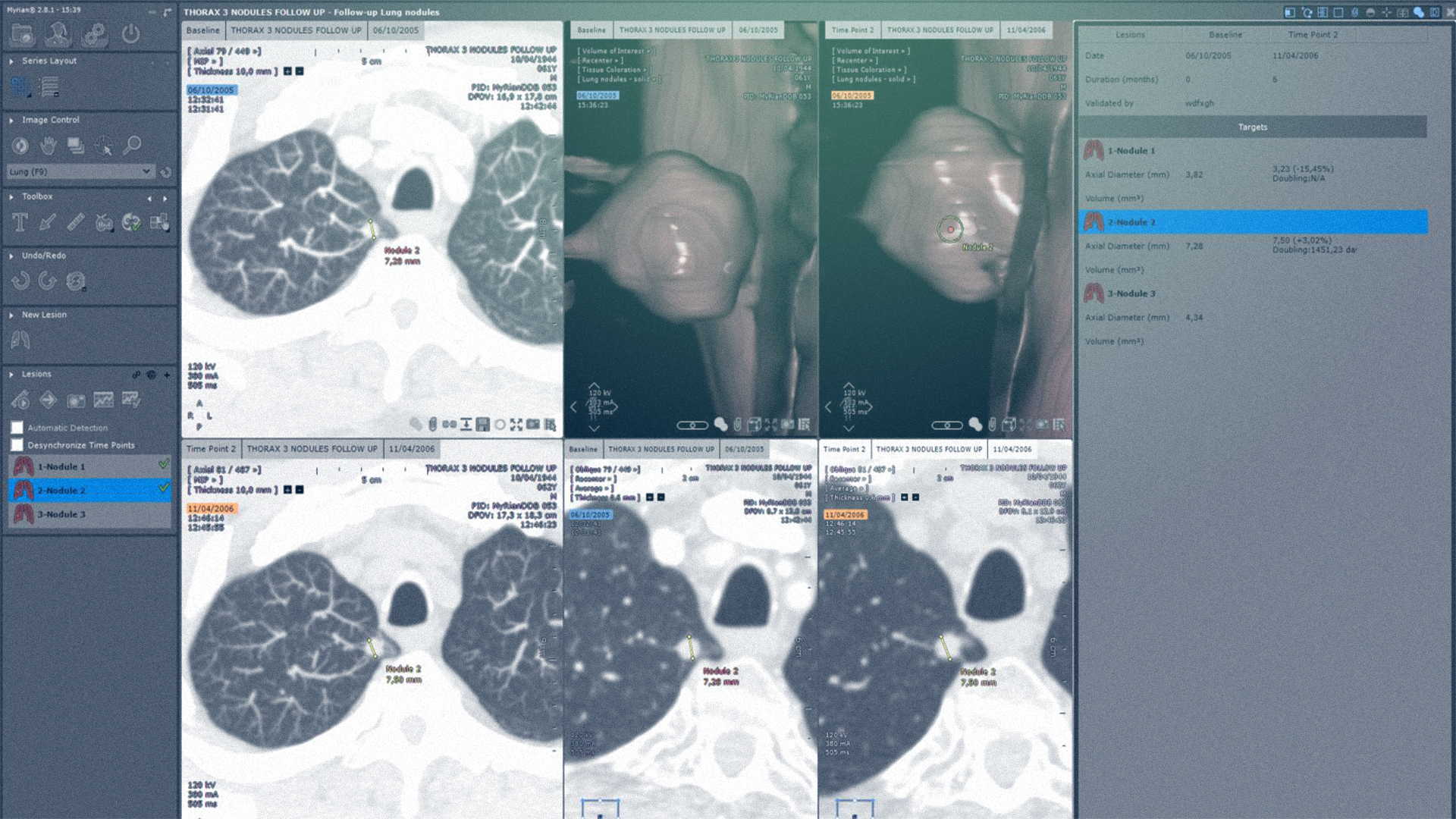 Logiciel montrant la segmentation des nodules pulmonaires - IRM Poumon - Intrasense - Logiciel Imagerie Médicale, Myrian®