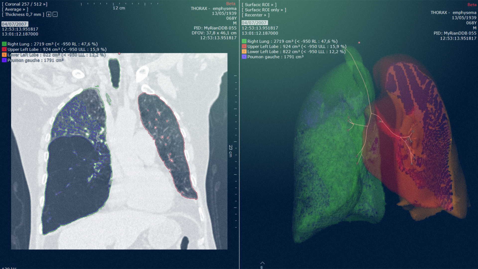 Visualisation 3D dans les moindres détails - IRM Poumon - Intrasense - Logiciel Imagerie Médicale, Myrian®