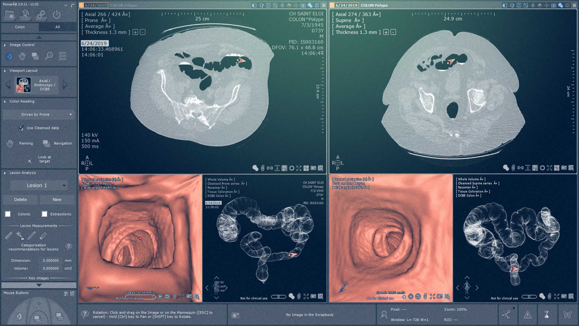 Images de scanner CT du grand intestin - Logiciel d'Imagerie - Intrasense - Logiciel Imagerie Médicale, Myrian®