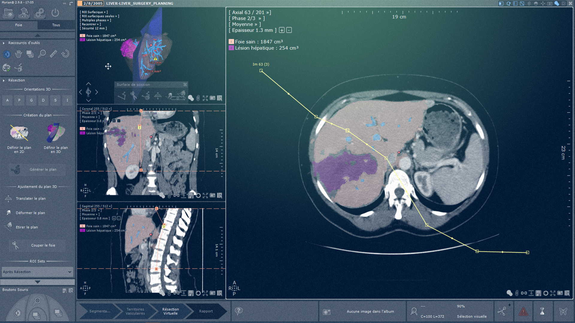 Logiciel montrant les images du scanner du foie - IRM Abdominal - Intrasense - Logiciel Imagerie Médicale, Myrian®