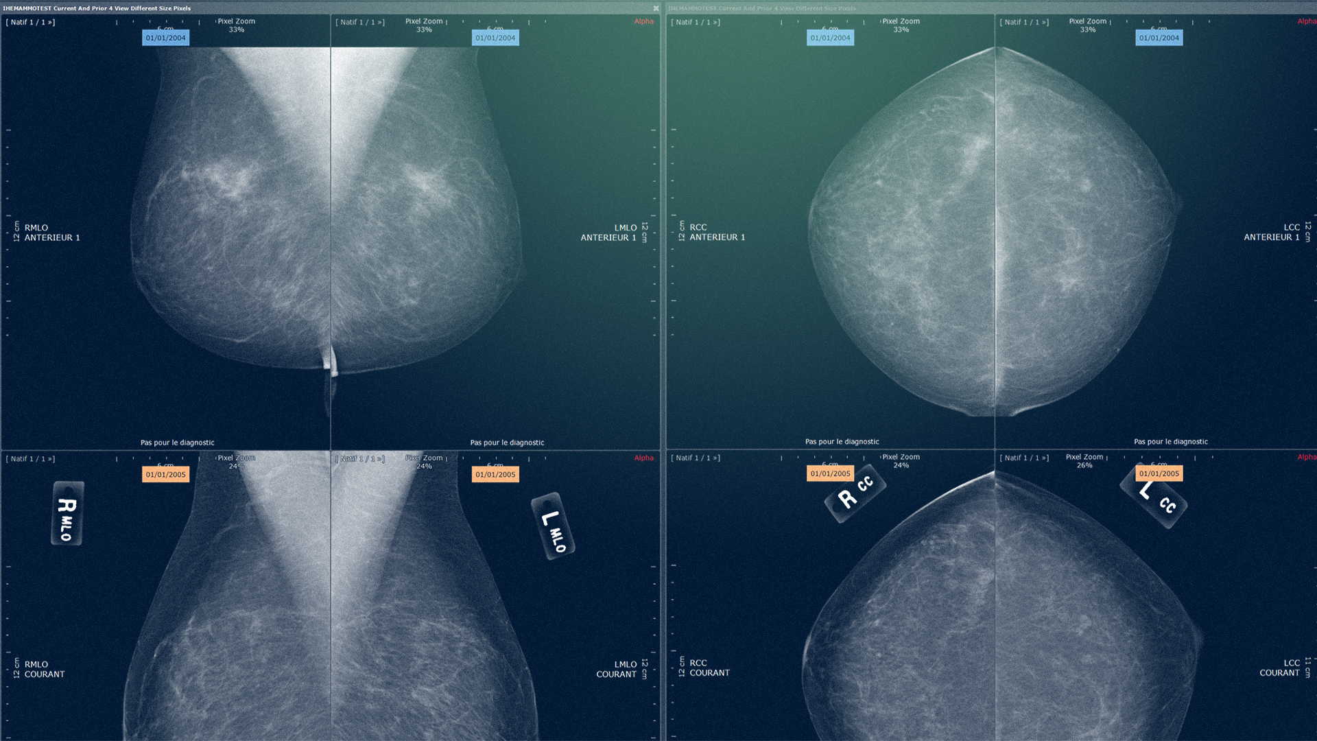 Gros plan sur les résultats d'une mammographie - Imagerie Cancer du Sein - Intrasense - Logiciel Imagerie Médicale, Myrian®