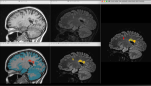 Résultats de la perfusion cérébrale - IRM AVC - Intrasense - Logiciel Imagerie Médicale, Myrian®